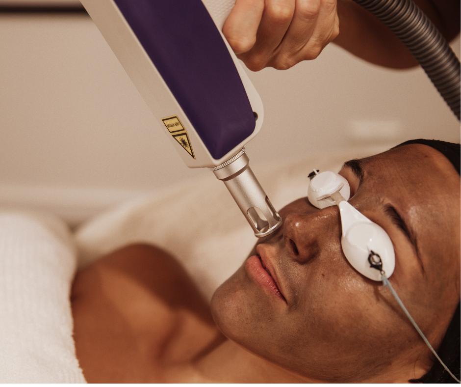 The Carbon Laser Facial